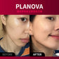 BEAUND BEA-PNV PLASNOVA 冷等離子皮膚護理儀